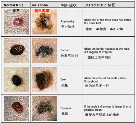 大痦子|有这5种“痣”要小心，可能会恶变